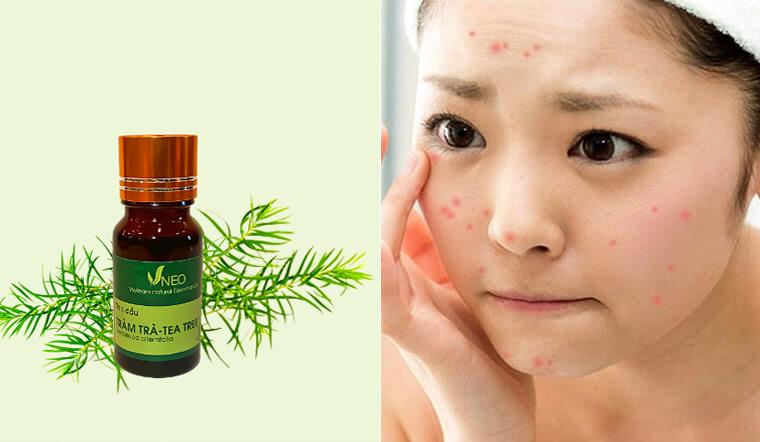 Trị mụn bằng tinh dầu tràm trà có an toàn hay không?